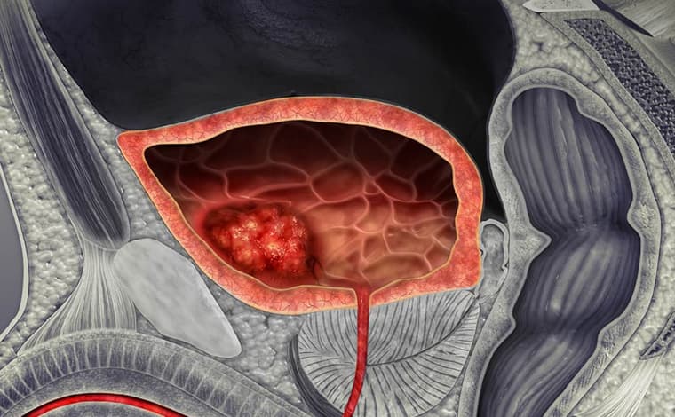 Cáncer de vejiga