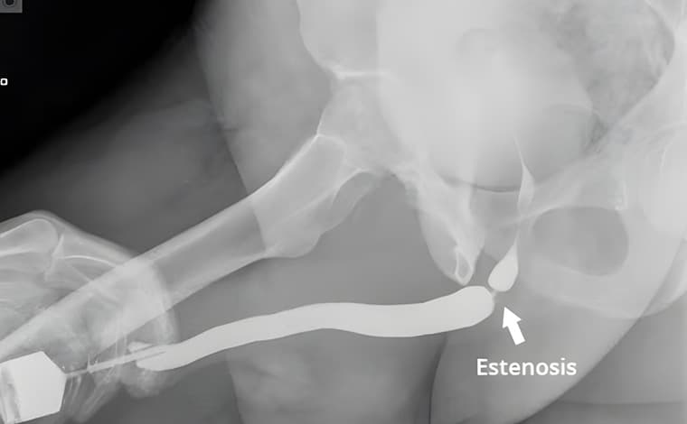 Estenosis uretral