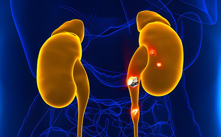 Tratamiento de litiasis renal